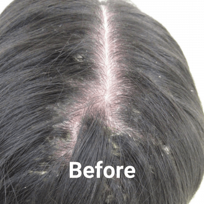 light treatment for scalp psoriasis