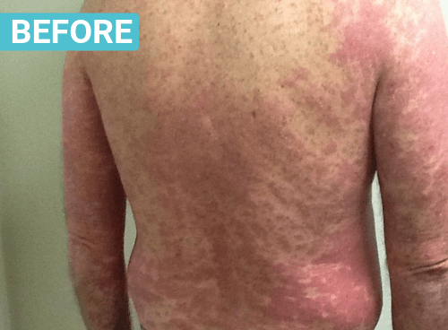 psoriasis and light therapy