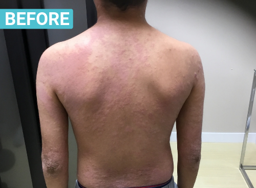 puva therapy for eczema