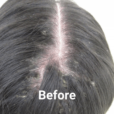 Targeted Narrowband UVB Laser Treatment for Scalp Psoriasis - Array ...