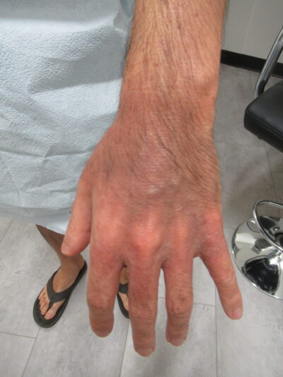 Eczema after photo