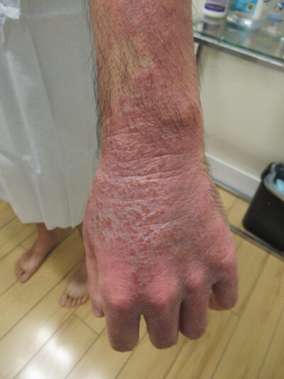 Eczema before photo