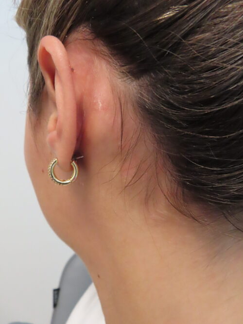 Psoriasis on Neck After