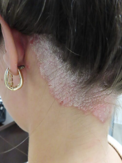 Psoriasis on Neck Before